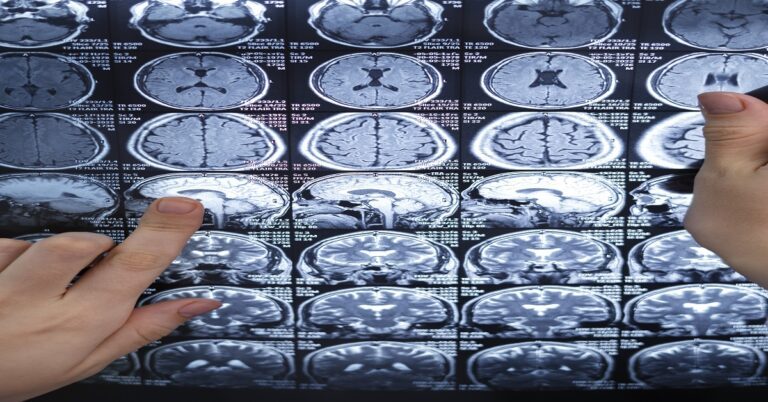 Brain Tumor Segmentation using Convolutional Neural Networks in MRI Images